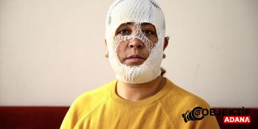 Adana039da-cilt-bakimi-sonrasi-yuzunde-yanik-olustugunu-iddia-eden-kadin.jpg