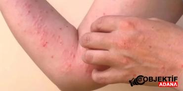 turkiye-kirmizi-alarm-listesinde-chikungunya-salgini-w1rs.jpg