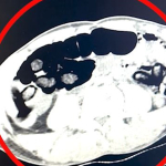 midelerinden-2-kilo-700-gram-uyusturucu-madde-cikti-55lu.jpg